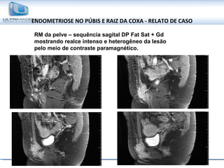 ENDOMETRIOSE NO PÚBIS E RAIZ DA COXA - RELATO DE CASO RM da pelve – sequência sagital DP Fat Sat + Gd mostrando realce intenso e heterogêneo da lesão pelo meio de contraste paramagnético. 
