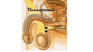 Vasectomia

 