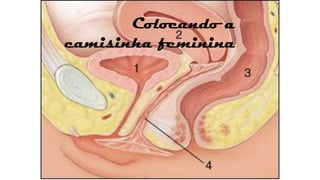 Colocando a
camisinha feminina

 