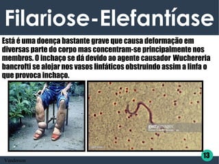 Filariose-Elefantíase
Está é uma doença bastante grave que causa deformação em
diversas parte do corpo mas concentram-se principalmente nos
membros. O inchaço se dá devido ao agente causador Wuchereria
bancrofti se alojar nos vasos linfáticos obstruindo assim a linfa o
que provoca inchaço.
13
Vanderson
 