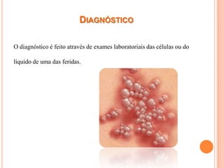 DIAGNÓSTICO

O diagnóstico é feito através de exames laboratoriais das células ou do

líquido de uma das feridas.
 