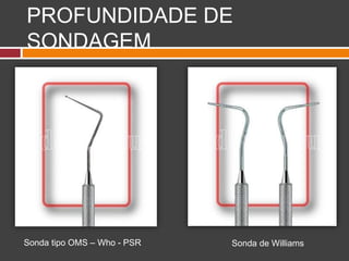 PROFUNDIDADE DE
SONDAGEM
Sonda tipo OMS – Who - PSR Sonda de Williams
 