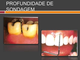 PROFUNDIDADE DE
SONDAGEM
 