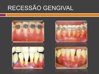 RECESSÃO GENGIVAL
 