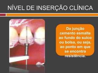 NÍVEL DE INSERÇÃO CLÍNICA
Da junção
cemento esmalte
ao fundo do sulco
ou bolsa, ou seja,
ao ponto em que
se encontra
resistência.
 