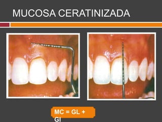 MUCOSA CERATINIZADA
MC = GL +
GI
 