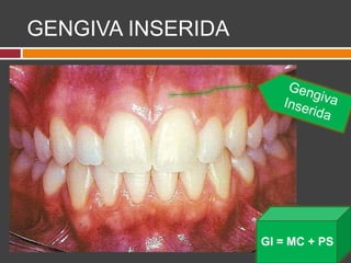 GENGIVA INSERIDA
GI = MC + PS
 