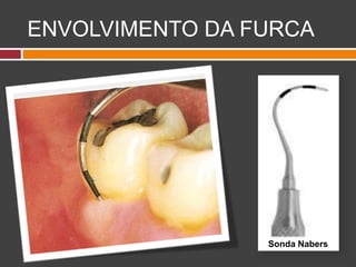 ENVOLVIMENTO DA FURCA
Sonda Nabers
 
