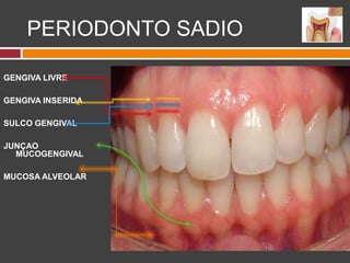PERIODONTO SADIO
GENGIVA LIVRE
GENGIVA INSERIDA
SULCO GENGIVAL
JUNÇAO
MUCOGENGIVAL
MUCOSA ALVEOLAR
 
