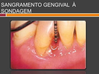 SANGRAMENTO GENGIVAL À
SONDAGEM
 