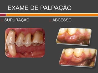 EXAME DE PALPAÇÃO
 SUPURAÇÃO  ABCESSO
 