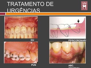 TRATAMENTO DE
URGÊNCIAS
GU
N
PUN
PERICORONARI
TE
ABC.
 