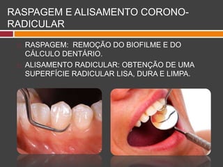 RASPAGEM E ALISAMENTO CORONO-
RADICULAR
 RASPAGEM: REMOÇÃO DO BIOFILME E DO
CÁLCULO DENTÁRIO.
 ALISAMENTO RADICULAR: OBTENÇÃO DE UMA
SUPERFÍCIE RADICULAR LISA, DURA E LIMPA.
 