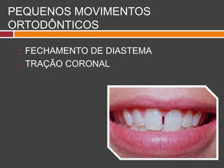 PEQUENOS MOVIMENTOS
ORTODÔNTICOS
 FECHAMENTO DE DIASTEMA
 TRAÇÃO CORONAL
 