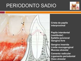 Crista da papila
interproximal
Papila interdental
(vestibular)
Epitélio juncional
Gengiva livre
Gengiva inserida
Limite mucogengival
Mucosa alveolar
Cemento radicular
Ligamento periodontal
Osso alveolar
PERIODONTO SADIO
 
