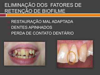 ELIMINAÇÃO DOS FATORES DE
RETENÇÃO DE BIOFILME
 RESTAURAÇÃO MAL ADAPTADA
 DENTES APINHADOS
 PERDA DE CONTATO DENTÁRIO
 