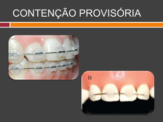 CONTENÇÃO PROVISÓRIA
 