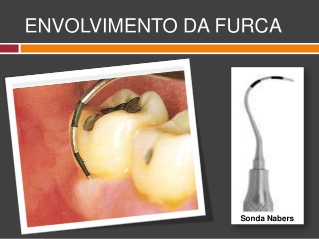 Resultado de imagen de exploracion furca con sonda de nabers