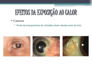 EFEITOS DA EXPOSIÇÃO AO CALOR
• Catarata
▫ Perda da transparência do cristalino (lente situada atrás da íris).
 