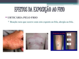 • URTICÁRIA PELO FRIO
▫ Reação rara que ocorre com esta exposto ao frio, alergia ao frio.
EFEITOS DA EXPOSIÇÃO AO FRIO
 