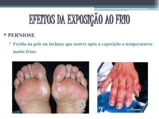 • PERNIOSE
▫ Ferida na pele ou inchaço que ocorre após a exposição a temperaturas
muito frias;
EFEITOS DA EXPOSIÇÃO AO FRIO
 