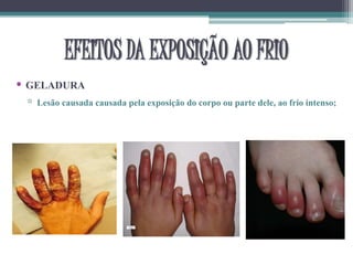 • GELADURA
▫ Lesão causada causada pela exposição do corpo ou parte dele, ao frio intenso;
EFEITOS DA EXPOSIÇÃO AO FRIO
 