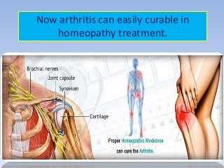 Now arthritis can easily curable in
homeopathy treatment.
 
