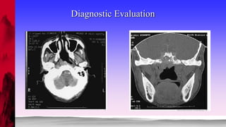 NASOPHARYNGEAL CARCINOMA | PPTX