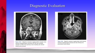 NASOPHARYNGEAL CARCINOMA | PPTX