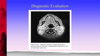 NASOPHARYNGEAL CARCINOMA | PPTX