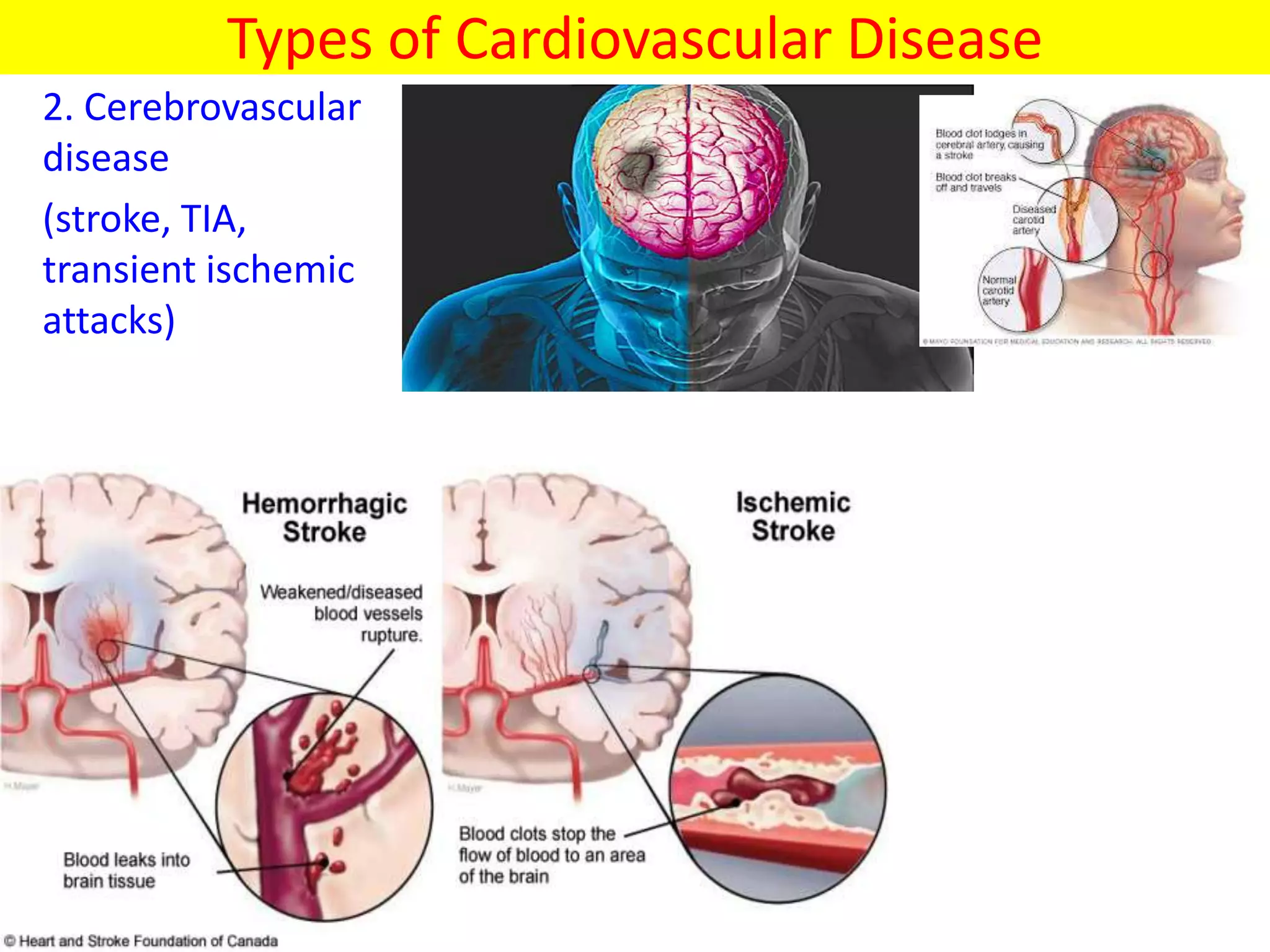 Types of Cardiovascular Disease
2. Cerebrovascular
disease
(stroke, TIA,
transient ischemic
attacks)
 