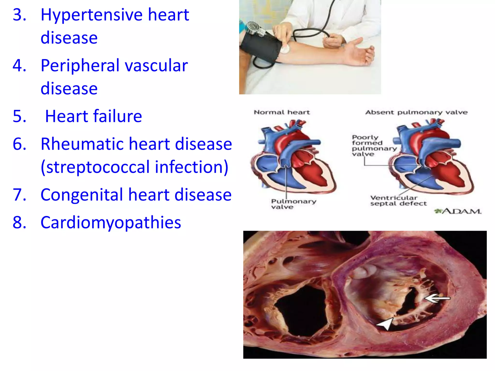 3. Hypertensive heart
disease
4. Peripheral vascular
disease
5. Heart failure
6. Rheumatic heart disease
(streptococcal infection)
7. Congenital heart disease
8. Cardiomyopathies
 