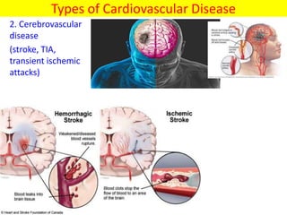 Types of Cardiovascular Disease
2. Cerebrovascular
disease
(stroke, TIA,
transient ischemic
attacks)
 