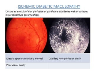 Non Proliferative Diabetic Retinopathy | PPTX