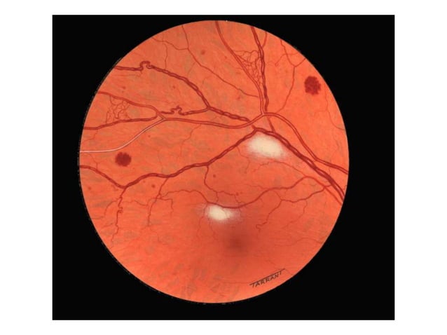 Non Proliferative Diabetic Retinopathy | PPTX | Diabetes | Diseases and ...