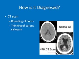 CT scan Rounding of horns Thinning of corpus callosum How is it Diagnosed? 