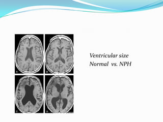Ventricular size
Normal vs. NPH

 