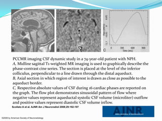PCCMR imaging CSF dynamic study in a 74-year-old patient with NPH.
A, Midline sagittal T1-weighted MR imaging is used to graphically describe the
phase-contrast cine series. The section is placed at the level of the inferior
colliculus, perpendicular to a line drawn through the distal aqueduct.
B, Axial section in which region of interest is drawn as close as possible to the
aqueduct border.
C, Respective absolute values of CSF during 16 cardiac phases are reported on
the graph. The flow plot demonstrates sinusoidal pattern of flow where
negative values represent aqueductal systolic CSF volume (microliter) outflow
and positive values represent diastolic CSF volume inflow.
Scollato A et al. AJNR Am J Neuroradiol 2008;29:192-197

©2008 by American Society of Neuroradiology

 