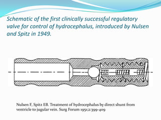 Schematic of the first clinically successful regulatory
valve for control of hydrocephalus, introduced by Nulsen
and Spitz in 1949.

Nulsen F, Spitz EB. Treatment of hydrocephalus by direct shunt from
ventricle to jugular vein. Surg Forum 1951;2:399-409

 