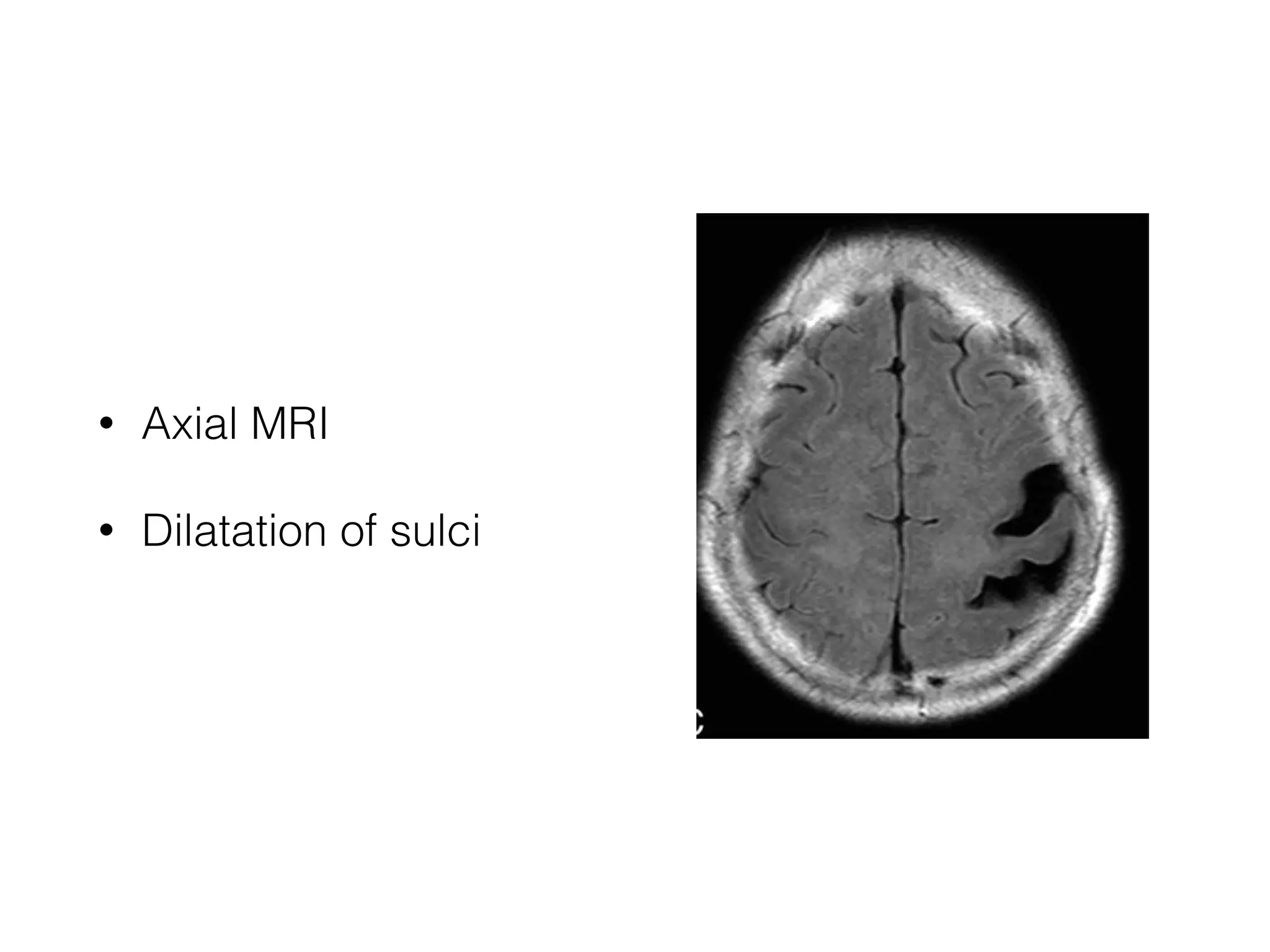 • Axial MRI
• Dilatation of sulci
 
