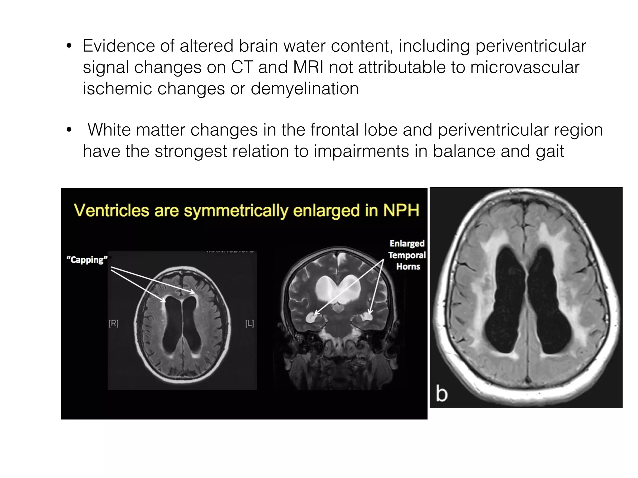 • Evidence of altered brain water content, including periventricular
signal changes on CT and MRI not attributable to microvascular
ischemic changes or demyelination
• White matter changes in the frontal lobe and periventricular region
have the strongest relation to impairments in balance and gait
 