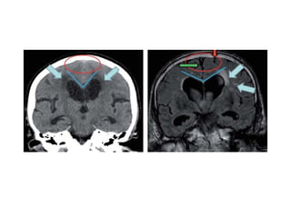 Nph Pathophys Surgical management of NPH | PPT