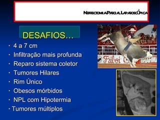 DESAFIOS…   4 a 7 cm Infiltração mais profunda  Reparo sistema coletor Tumores Hilares Rim Único Obesos mórbidos NPL com Hipotermia Tumores múltiplos Nefrectomia Parcial Laparoscópica 