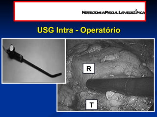 USG Intra - Operatório  R T Nefrectomia Parcial Laparoscópica 