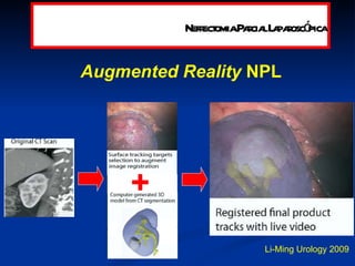 Augmented Reality  NPL Li-Ming Urology 2009 Nefrectomia Parcial Laparoscópica + 