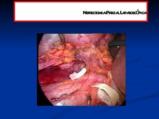 Nefrectomia Parcial Laparoscópica 