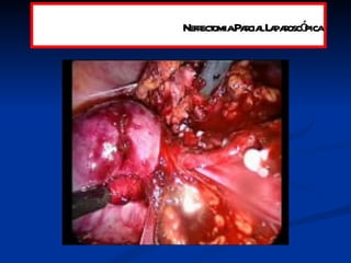 Nefrectomia Parcial Laparoscópica 