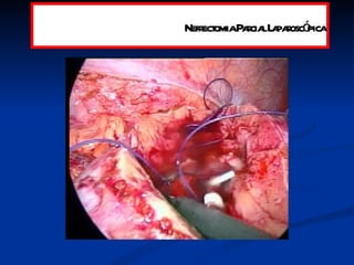 Nefrectomia Parcial Laparoscópica 