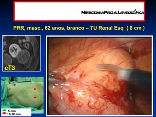 PRR, masc., 62 anos, branco – TU Renal Esq  ( 8 cm ) cT3 Nefrectomia Parcial Laparoscópica 5 mm  10/12 mm 