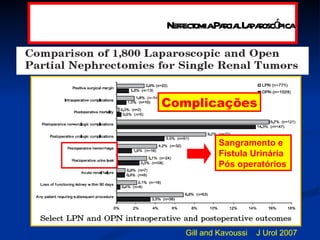 Gill and Kavoussi  J Urol 2007  Complicações Sangramento e  Fistula Urinária Pós operatórios Nefrectomia Parcial Laparoscópica 